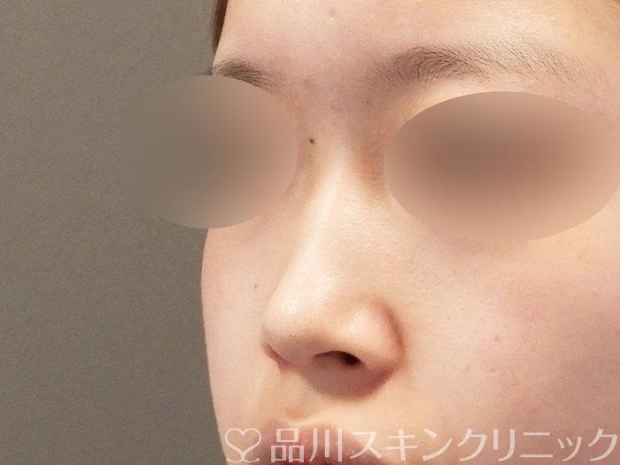 症例NO.64916のBEFORE写真