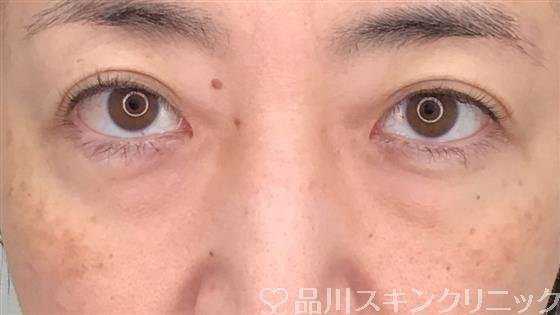 症例NO.56120のBEFORE写真