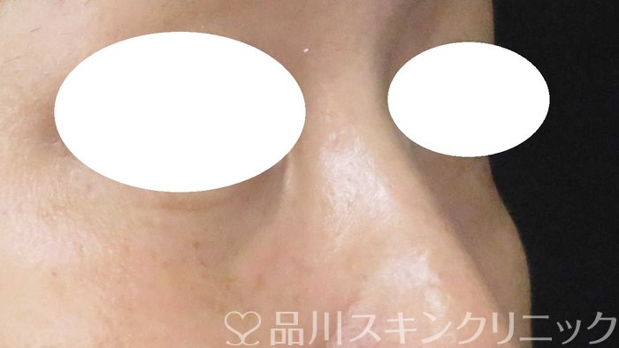 症例NO.66456のBEFORE写真