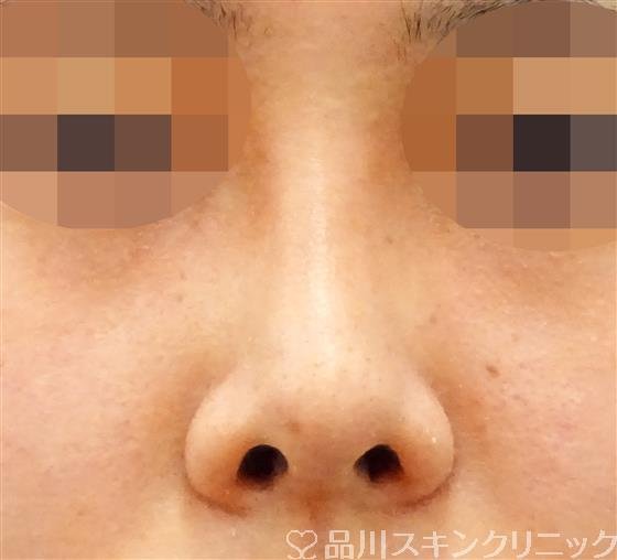 症例NO.45707のBEFORE写真