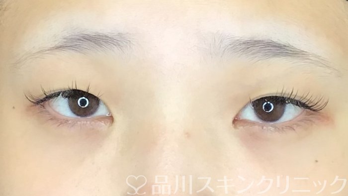 症例NO.66858のBEFORE写真