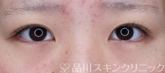 症例NO.66026のBEFORE写真