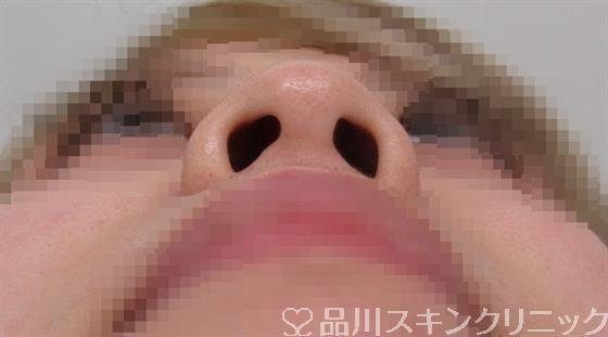 症例NO.47128のBEFORE写真