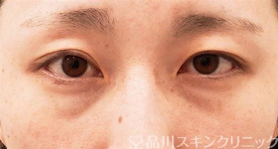 症例NO.61488のBEFORE写真