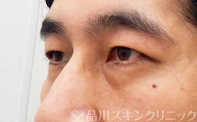 症例NO.62240のBEFORE写真