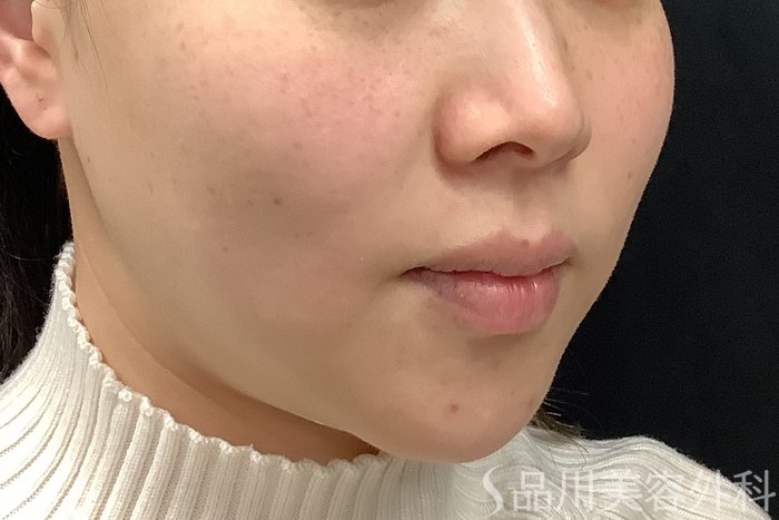 症例NO.65200のBEFORE写真