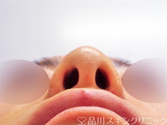 症例NO.49946のAFTER写真