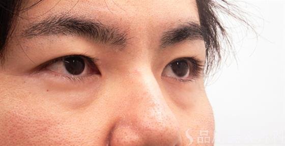 症例NO.53018のBEFORE写真