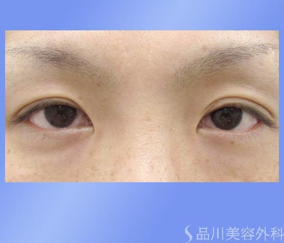 症例NO.1070のBEFORE写真