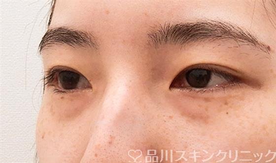 症例NO.61511のBEFORE写真