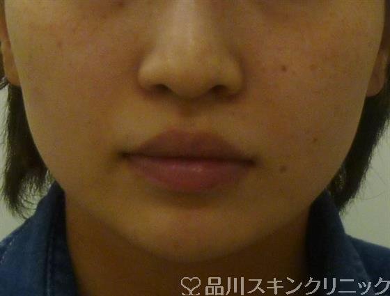 症例NO.40291のBEFORE写真