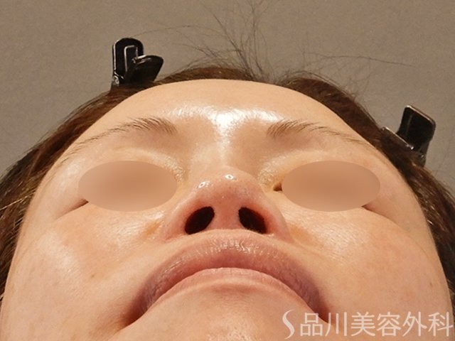 症例NO.65834のBEFORE写真