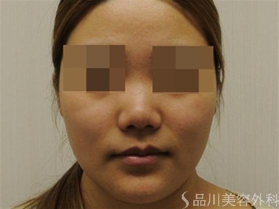 症例NO.18414のBEFORE写真