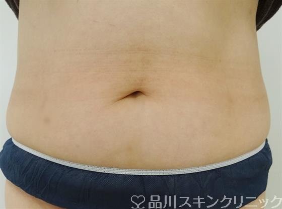 症例NO.32201のBEFORE写真