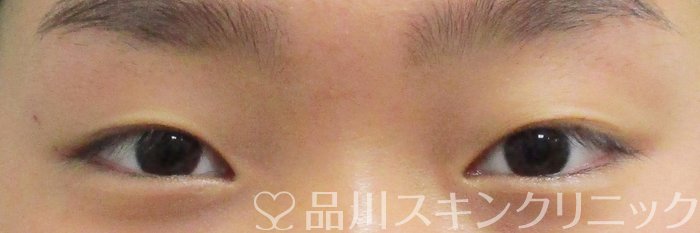 症例NO.68190のBEFORE写真