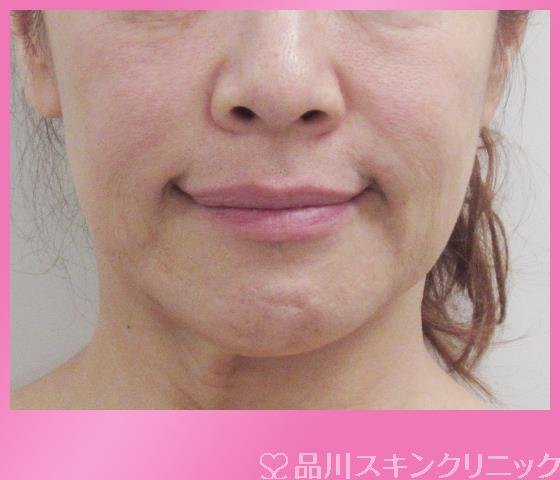 症例NO.28030のBEFORE写真