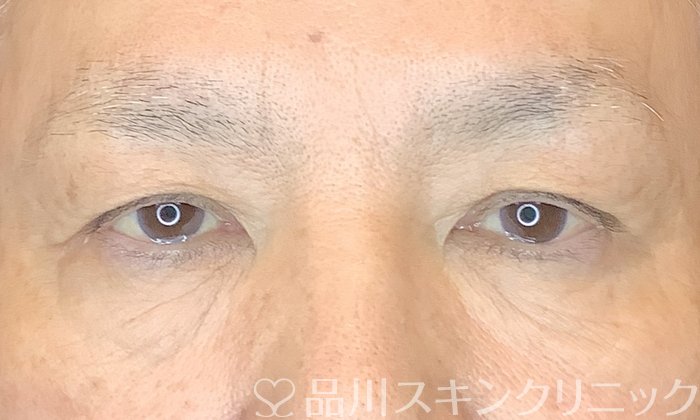 症例NO.67332のBEFORE写真