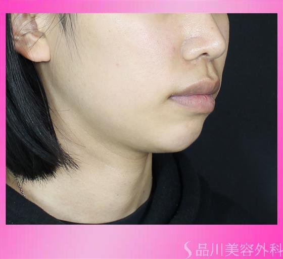 症例NO.53699のBEFORE写真