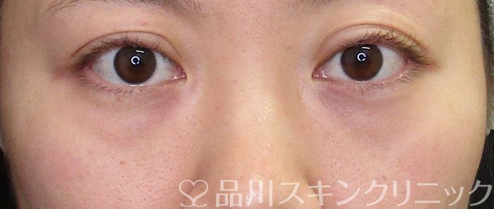 症例NO.66201のBEFORE写真