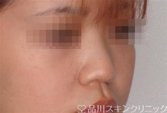 症例NO.50978のBEFORE写真