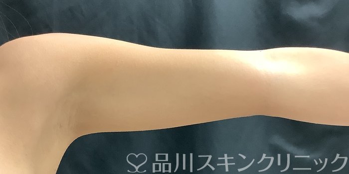 症例NO.68478のBEFORE写真