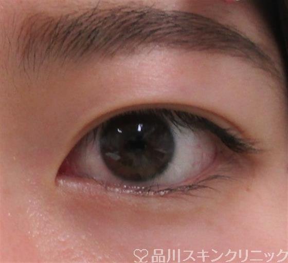 症例NO.30996のBEFORE写真