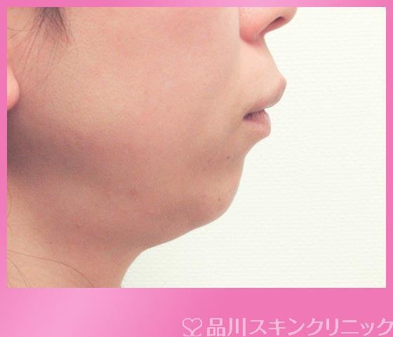 症例NO.27200のBEFORE写真