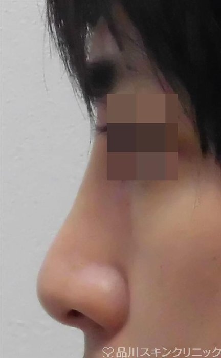 症例NO.40136のAFTER写真