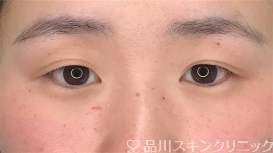 症例NO.57309のBEFORE写真