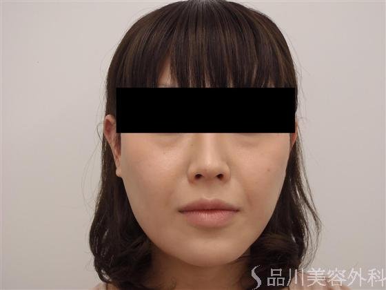 症例NO.6171のBEFORE写真