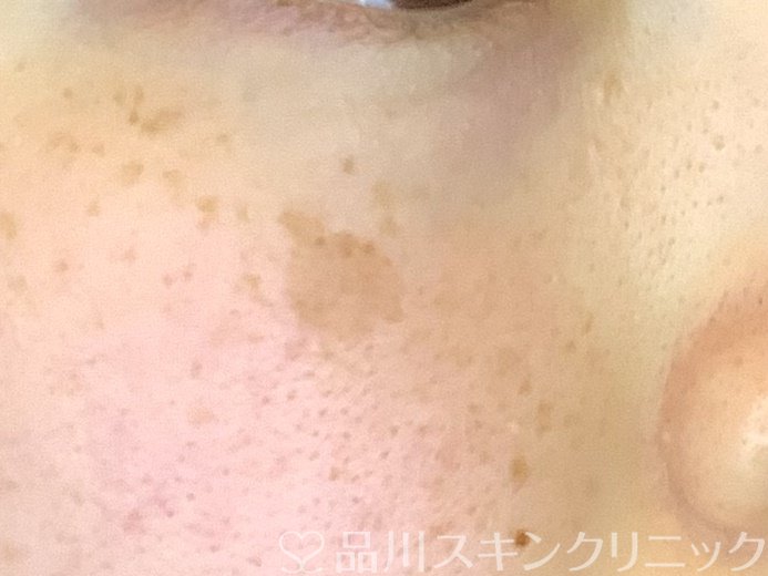 症例NO.69127のBEFORE写真