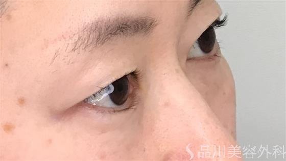 症例NO.56179のBEFORE写真