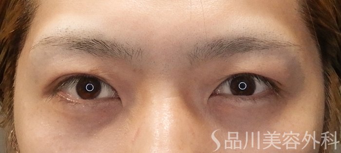 症例NO.67165のBEFORE写真