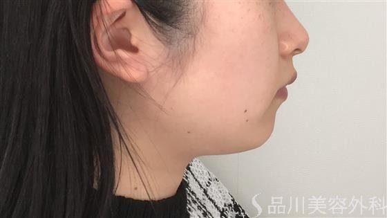 症例NO.60096のBEFORE写真