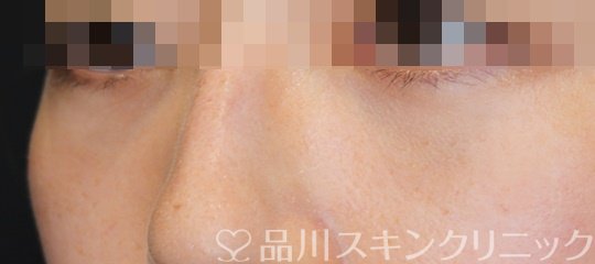 症例NO.64269のAFTER写真