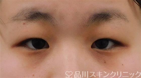 症例NO.41200のBEFORE写真