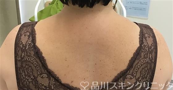 症例NO.53769のBEFORE写真