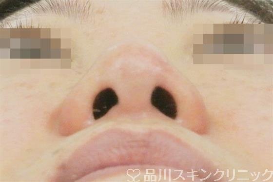 症例NO.38064のBEFORE写真