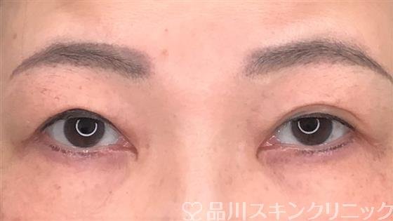 症例NO.58507のBEFORE写真