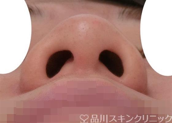 症例NO.31145のBEFORE写真