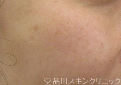 症例NO.65750のBEFORE写真