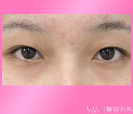 症例NO.2038のBEFORE写真