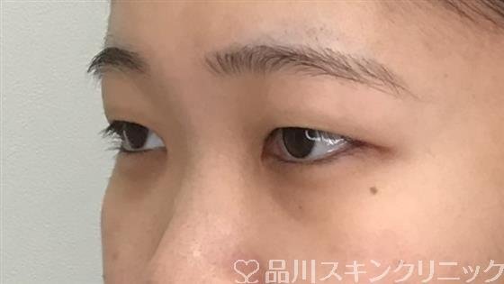 症例NO.56620のBEFORE写真