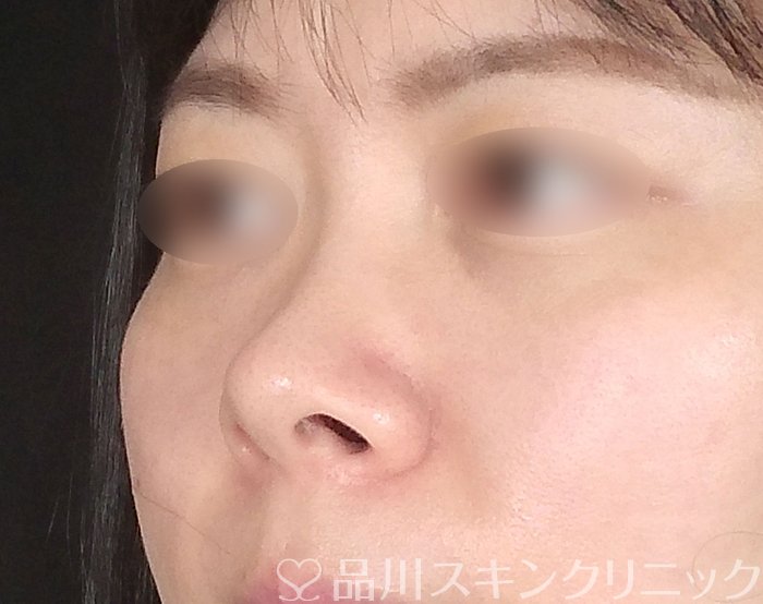 症例NO.69040のBEFORE写真