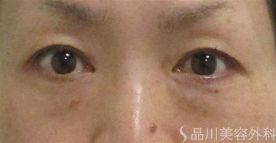 症例NO.58624のBEFORE写真