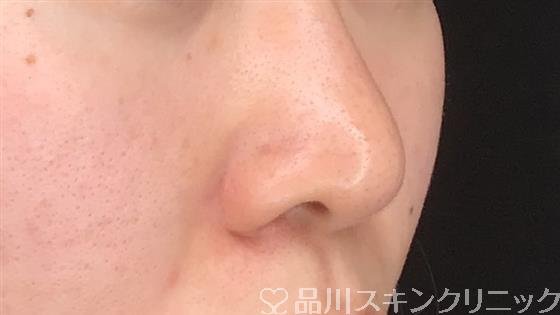 症例NO.60749のBEFORE写真