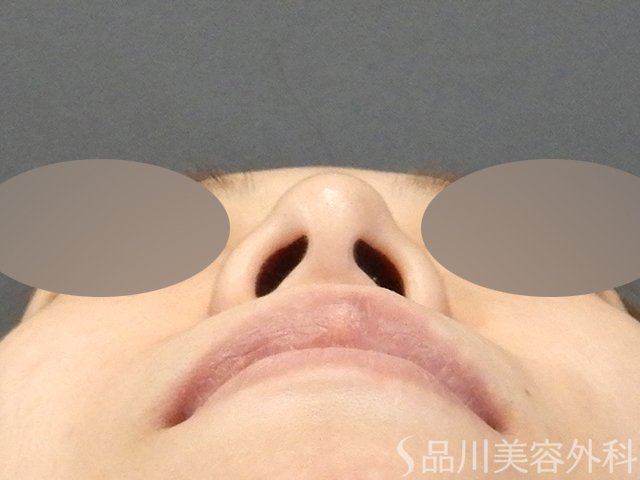 症例NO.64935のBEFORE写真