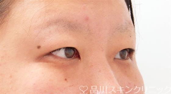 症例NO.54006のBEFORE写真