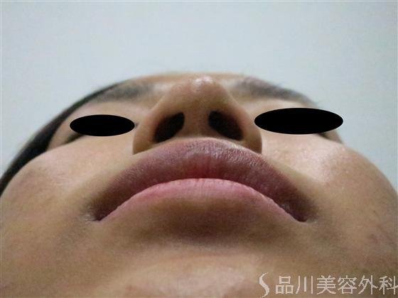 症例NO.13678のBEFORE写真