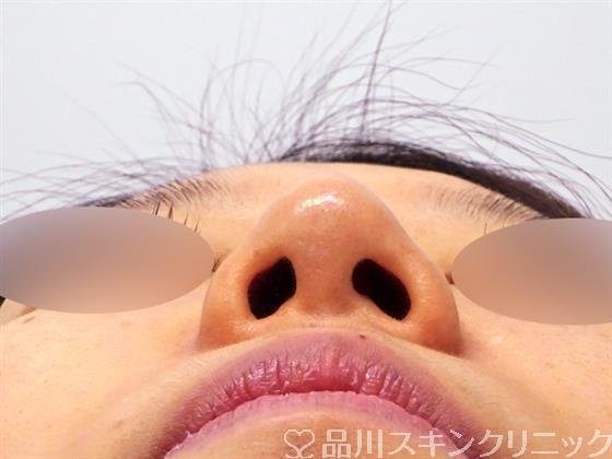 症例NO.49945のBEFORE写真